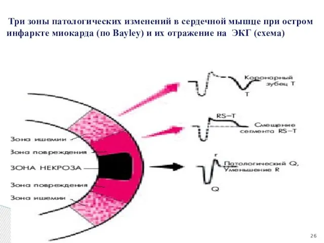 Три зоны патологических изменений в сердечной мышце при остром инфаркте миокарда