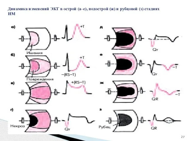 Динамика изменений ЭКГ в острой (а–е), подострой (ж) и рубцовой (з) стадиях ИМ