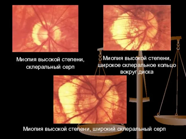 Миопия высокой степени, склеральный серп Миопия высокой степени, широкое склеральное кольцо