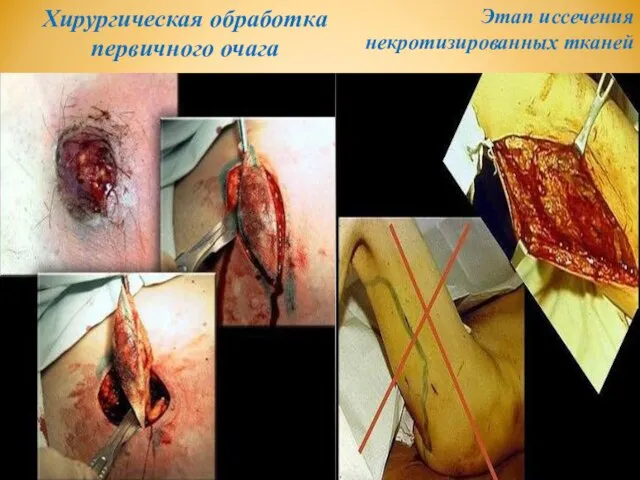 Хирургическая обработка первичного очага Этап иссечения некротизированных тканей