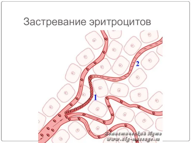 Застревание эритроцитов