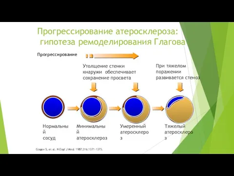 Прогрессирование атеросклероза: гипотеза ремоделирования Глагова Нормальный сосуд Прогрессирование Glagov S, et