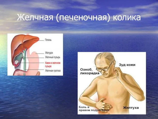 Желчная (печеночная) колика