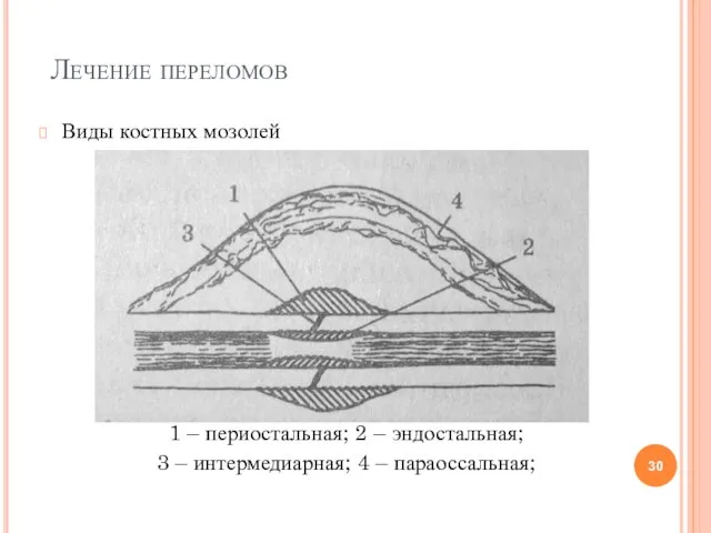 Лечение переломов Виды костных мозолей 1 – периостальная; 2 – эндостальная;