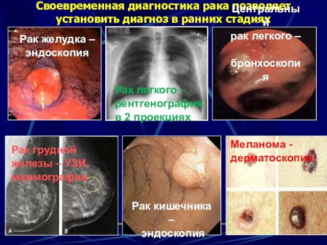 Своевременная диагностика рака позволяет установить диагноз в ранних стадиях Рак желудка