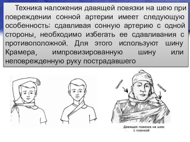 Техника наложения давящей повязки на шею при повреждении сонной артерии имеет