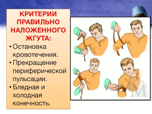 КРИТЕРИИ ПРАВИЛЬНО НАЛОЖЕННОГО ЖГУТА: Остановка кровотечения. Прекращение периферической пульсации. Бледная и холодная конечность.