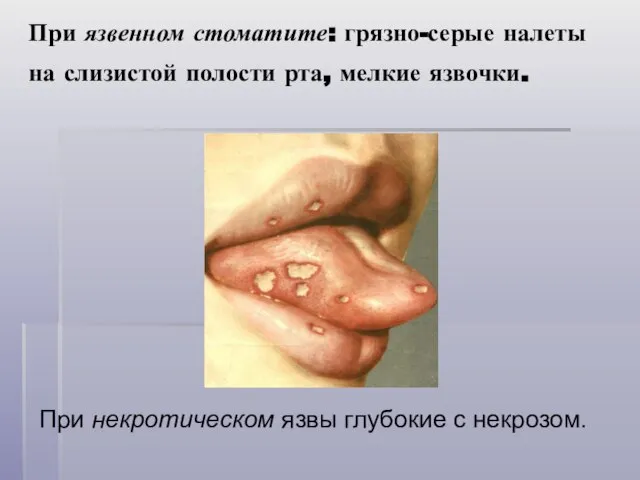При язвенном стоматите: грязно-серые налеты на слизистой полости рта, мелкие язвочки.