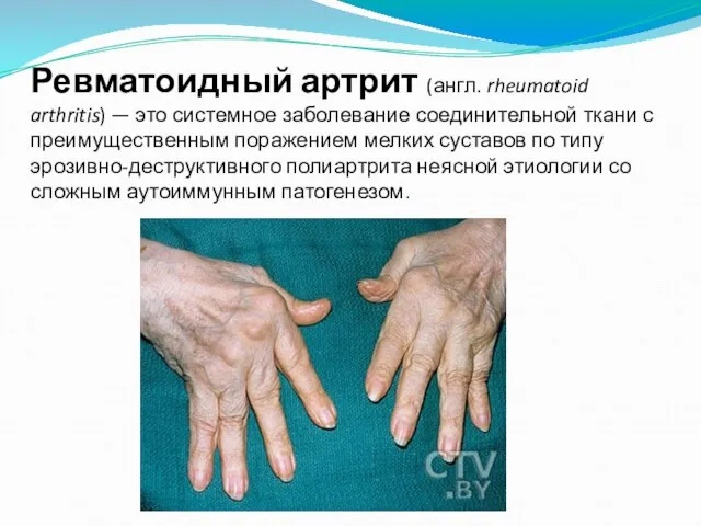 Ревматоидный артрит (англ. rheumatoid arthritis) — это системное заболевание соединительной ткани