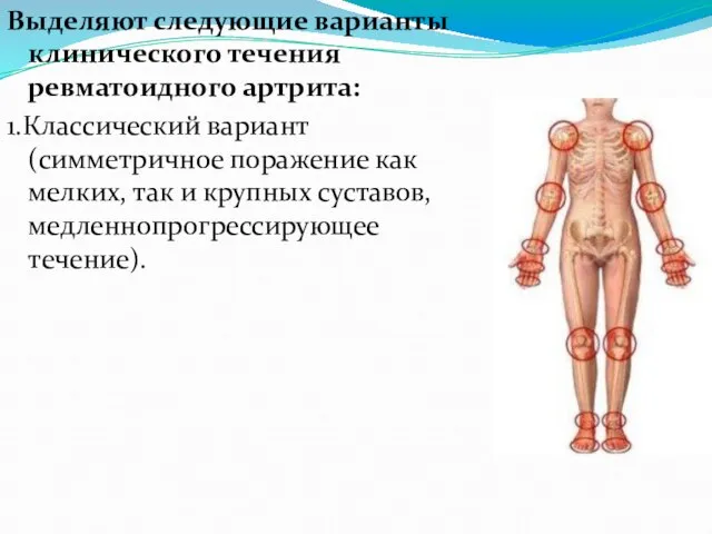 Выделяют следующие варианты клинического течения ревматоидного артрита: 1.Классический вариант (симметричное поражение