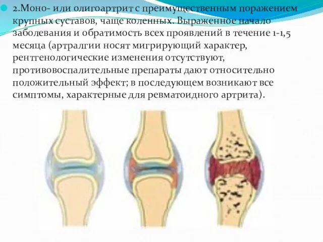 2.Моно- или олигоартрит с преимущественным поражением крупных суставов, чаще коленных. Выраженное