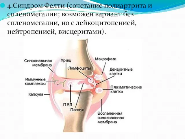 4.Синдром Фелти (сочетание полиартрита и спленомегалии; возможен вариант без спленомегалии, но с лейкоцитопенией, нейтропенией, висцеритами).