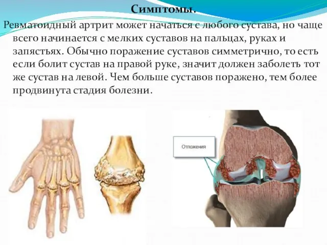 Симптомы. Ревматоидный артрит может начаться с любого сустава, но чаще всего