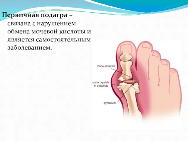 Первичная подагра – связана с нарушением обмена мочевой кислоты и является самостоятельным заболеванием.