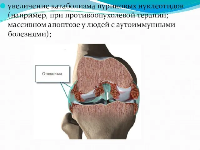 увеличение катаболизма пуриновых нуклеотидов (например, при противоопухолевой терапии; массивном апоптозе у людей с аутоиммунными болезнями);