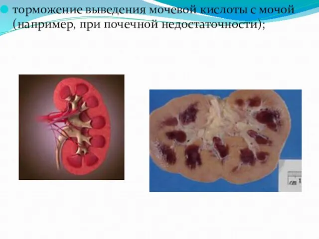 торможение выведения мочевой кислоты с мочой (например, при почечной недостаточности);