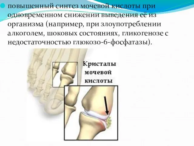 повышенный синтез мочевой кислоты при одновременном снижении выведения её из организма