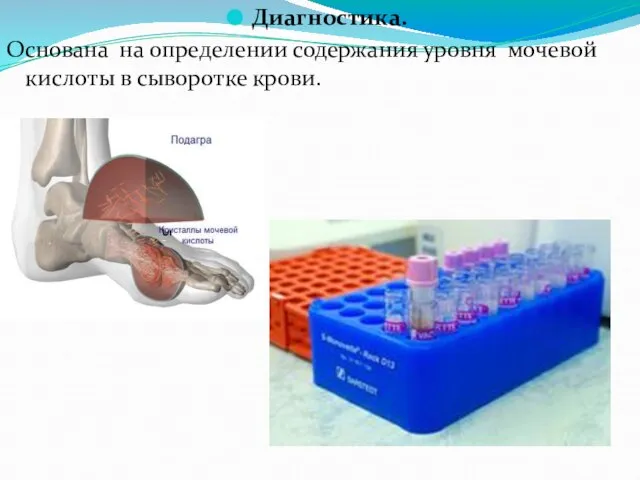 Диагностика. Основана на определении содержания уровня мочевой кислоты в сыворотке крови.