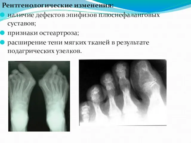 Рентгенологические изменения: наличие дефектов эпифизов плюснефаланговых суставов; признаки остеартроза; расширение тени