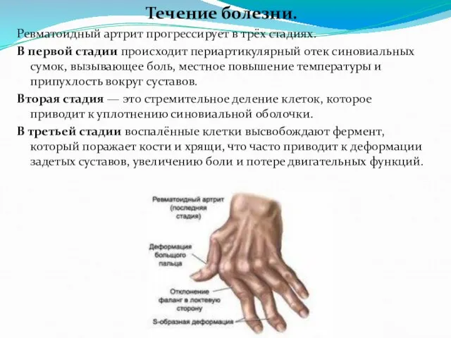 Течение болезни. Ревматоидный артрит прогрессирует в трёх стадиях. В первой стадии