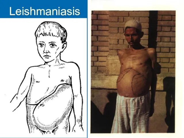 Leishmaniasis