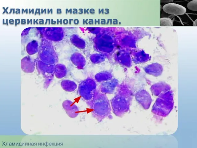 Хламидийная инфекция Хламидии в мазке из цервикального канала.