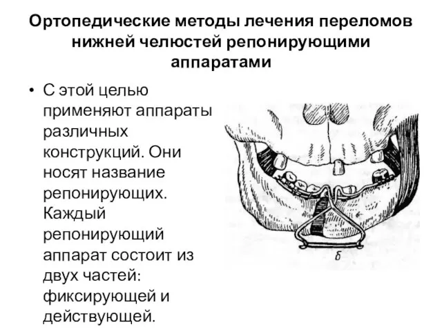 Ортопедические методы лечения переломов нижней челюстей репонирующими аппаратами С этой целью