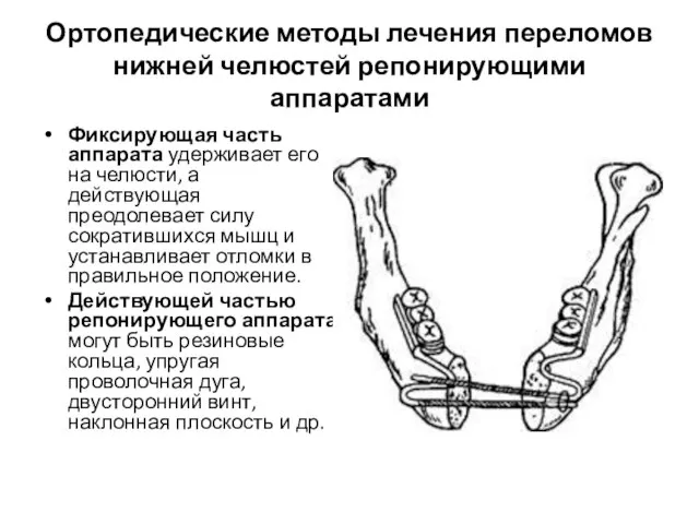 Ортопедические методы лечения переломов нижней челюстей репонирующими аппаратами Фиксирующая часть аппарата