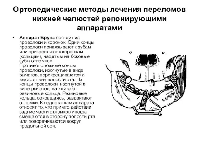 Ортопедические методы лечения переломов нижней челюстей репонирующими аппаратами Аппарат Бруна состоит