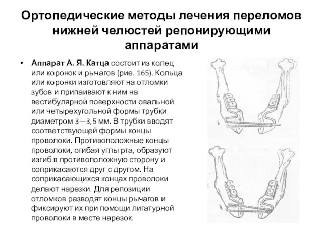 Ортопедические методы лечения переломов нижней челюстей репонирующими аппаратами Аппарат А. Я.