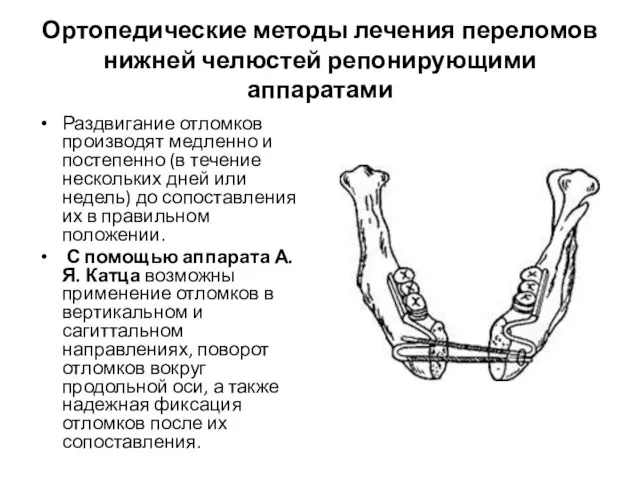 Ортопедические методы лечения переломов нижней челюстей репонирующими аппаратами Раздвигание отломков производят