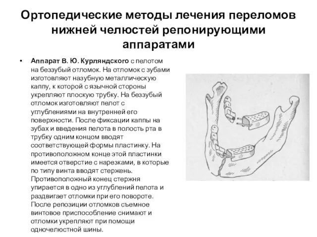 Ортопедические методы лечения переломов нижней челюстей репонирующими аппаратами Аппарат В. Ю.