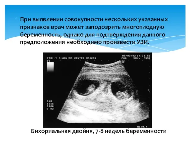 При выявлении совокупности нескольких указанных признаков врач может заподозрить многоплодную беременность,