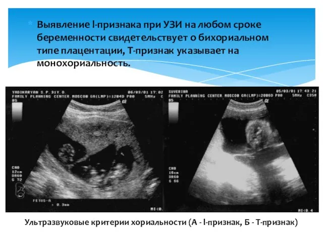 Выявление l-признака при УЗИ на любом сроке беременности свидетельствует о бихориальном