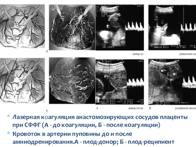 Лазерная коагуляция анастомозирующих сосудов плаценты при СФФГ (А - до коагуляции,