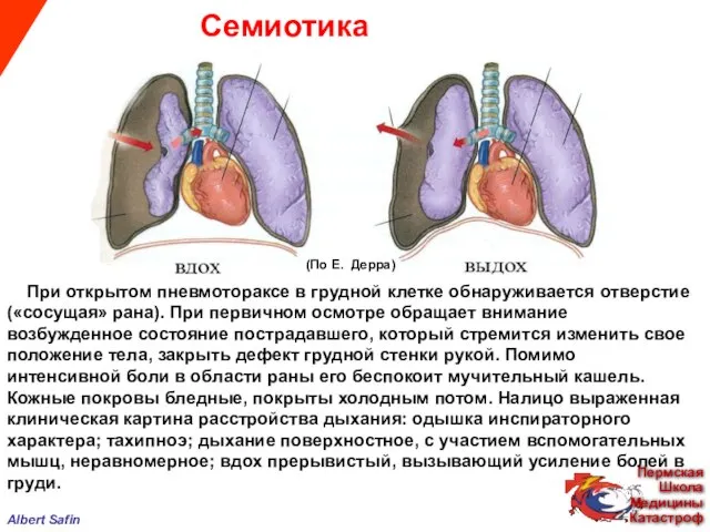 Семиотика Albert Safin При открытом пневмотораксе в грудной клетке обнаруживается отверстие