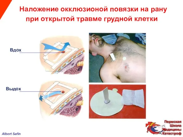 Albert Safin Наложение окклюзионой повязки на рану при открытой травме грудной клетки Вдох Выдох