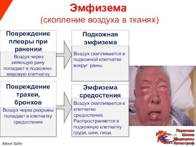 Эмфизема (скопление воздуха в тканях) Воздух через зияющую рану попадает в