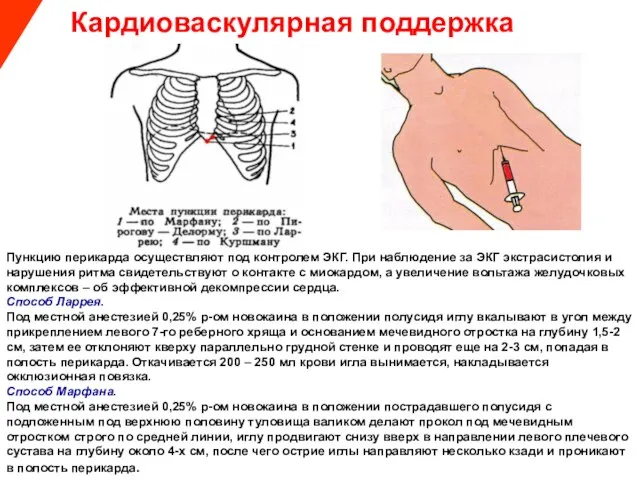 Кардиоваскулярная поддержка Пункцию перикарда осуществляют под контролем ЭКГ. При наблюдение за