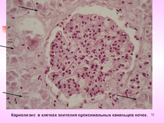 Кариолизис в клетках эпителия проксимальных канальцев почек.