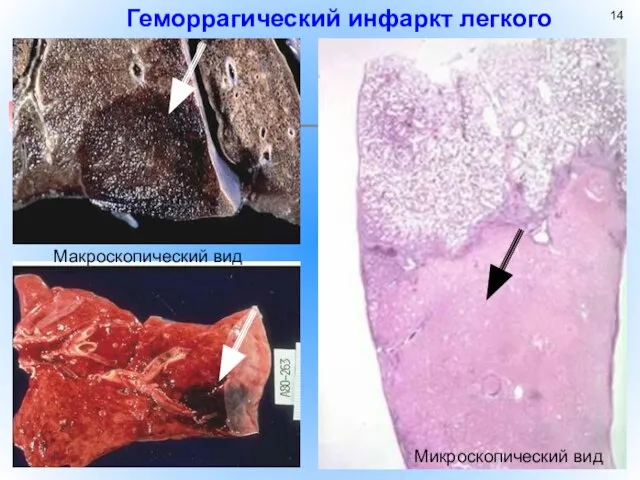 Микроскопический вид Геморрагический инфаркт легкого Макроскопический вид