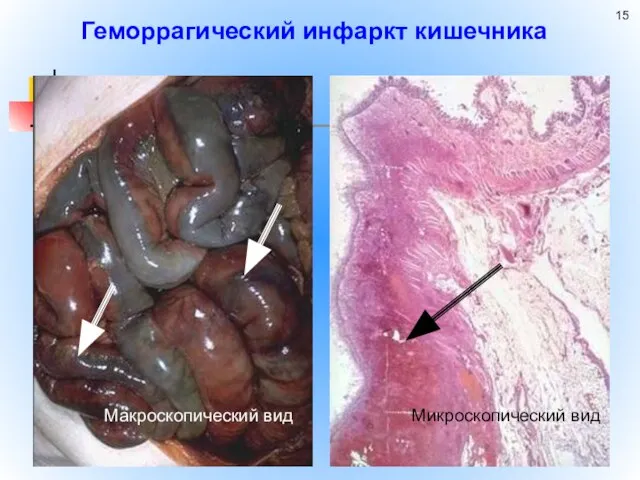 Геморрагический инфаркт кишечника Макроскопический вид Микроскопический вид