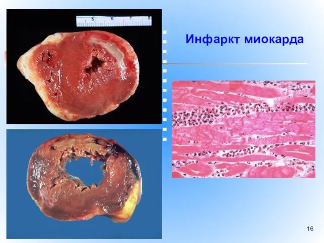 Инфаркт миокарда