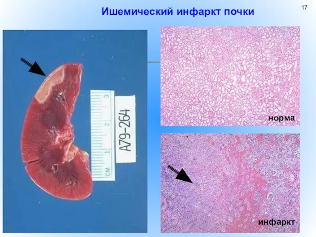 Ишемический инфаркт почки норма инфаркт