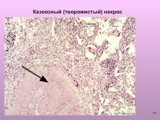 Казеозный (творожистый) некроз