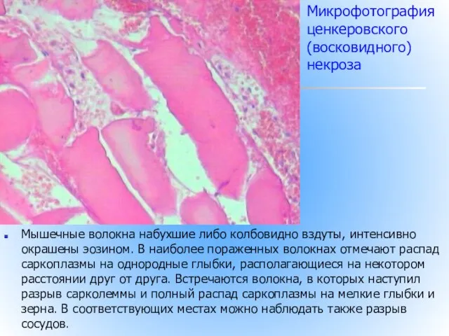 Мышечные волокна набухшие либо колбовидно вздуты, интенсивно окрашены эозином. В наиболее