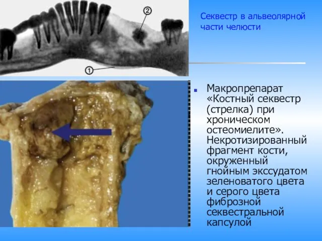 Макропрепарат «Костный секвестр (стрелка) при хроническом остеомиелите». Некротизированный фрагмент кости, окруженный