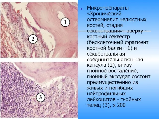 Микропрепараты «Хронический остеомиелит челюстных костей, стадия секвестрации»: вверху - костный секвестр