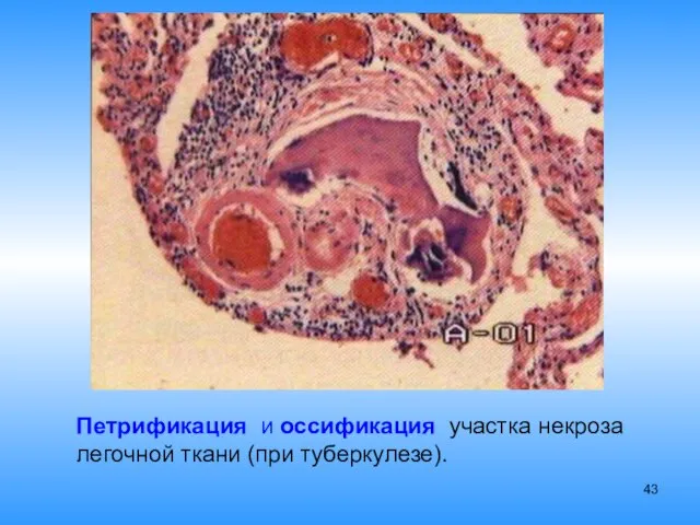 Петрификация и оссификация участка некроза легочной ткани (при туберкулезе).