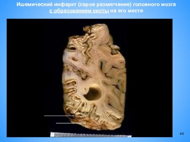 Ишемический инфаркт (серое размягчение) головного мозга с образованием кисты на его месте